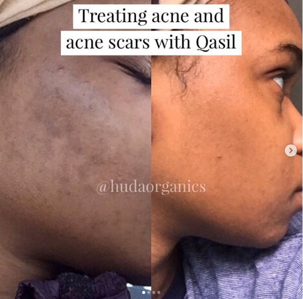 Top Best DIY Acne Face Mask For Dark Spots And Pigmentation